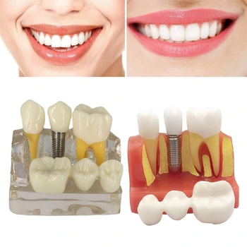 Zobu Zobu Implantācija, Modelis 4 Reizes Noņemams Vainagu Tilta Demonstrācijas Klases Izglītību un mācībām Zobu Modelis